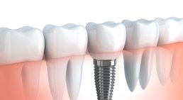 Implantat -