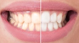 Bleaching -