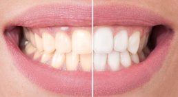Bleaching -