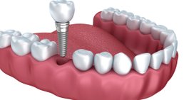 Implantat -