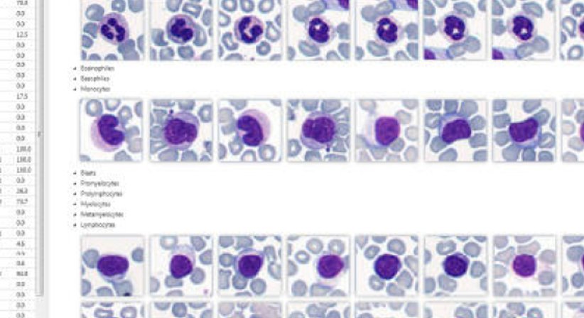 Behandlung Hämatologischer Grunderkrankungen   - OA Dr. Wolfgang Fiebiger - Internist Wien 1090