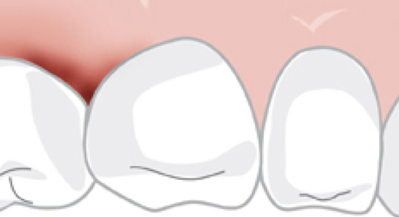 Parodontaltherapie - DDr. Oliver Sas - Zahnarzt Wien 1010