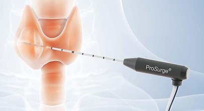 Radiofrequenzablation der Schilddrüsen als Alternative zur Operation