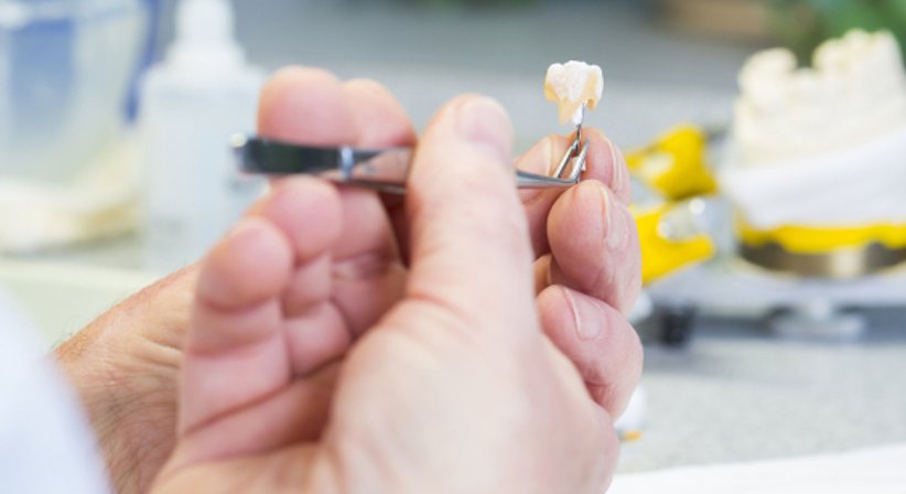 Füllungstherapie - Dr. Michael Leukauf - Zahnarzt Wien 1190