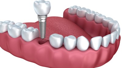 Implantate / Knochenaufbau