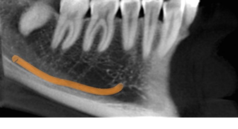 DVT - Digitale Volumentomographie - Dr. Michael Reisegger - Radiologe Mödling 2340