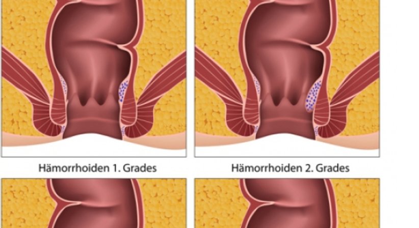 Hämorrhoiden - OA Priv. Doz. Dr. Alexander Prusa, FACS, FICS - Allgemeinchirurg Wien 1180