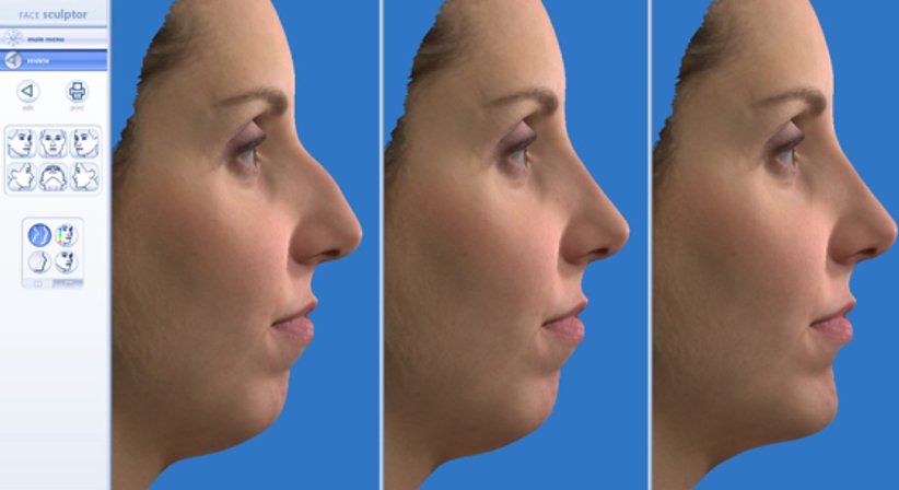 Lidstraffung - Univ.Doz. Dr. Rafic Kuzbari - Plastischer Chirurg Wien 1010