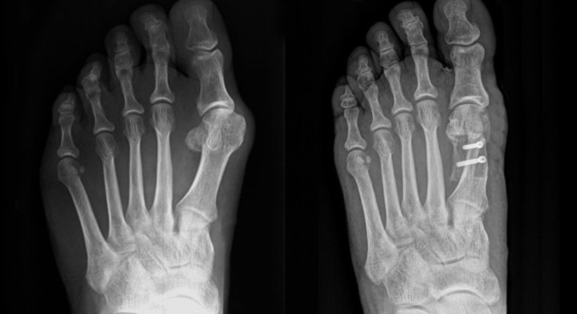 Hallux valgus - OA Dr. Thomas Czurda - Orthopäde Wien 1080