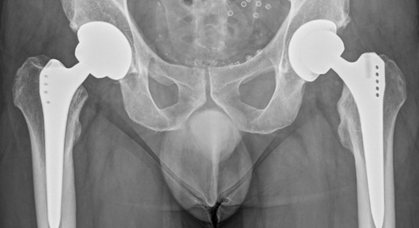 Hüftprothese - OA Dr. Thomas Czurda - Orthopäde Wien 1080