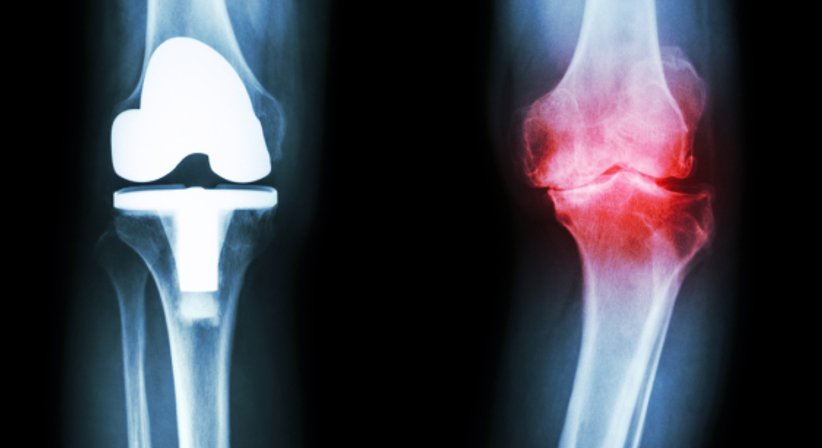 Knieprothese - OA Dr. Thomas Czurda - Orthopäde Wien 1080