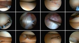 Arthroskopie -