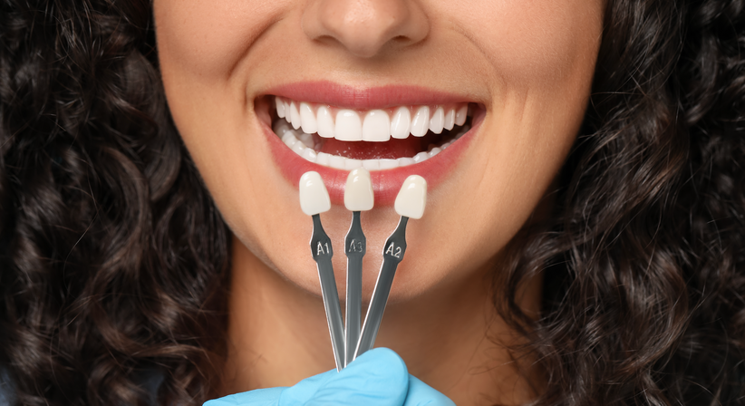 Veneers - Dr. med. dent. David Ungvari - Zahnarzt Graz 8010