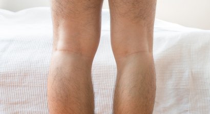 Beinachsenkorrektur (Umstellungsosteotomie)