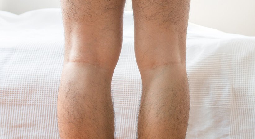 Beinachsenkorrektur (Umstellungsosteotomie) - Dr. René Könighofer - Orthopäde Graz 8010