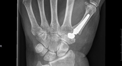Daumensattelgelenks-Totalendoprothese bei Rhizarthrose