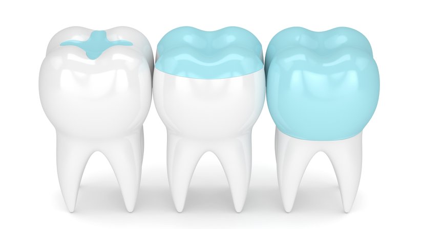 Inlays, Onlays, Teilkronen (CAD-CAM Verfahren) - Zahnklinik Wien Döbling -  Wien 1190