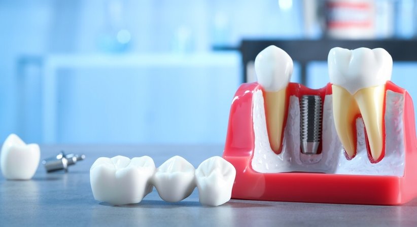 Kronen- und Brückenversorgung - metallfrei mit Zirkonkeramik - Zahnklinik Wien Döbling -  Wien 1190