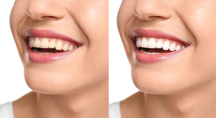 Zahnaufhellung (In-office und internes Bleaching) - Zahnklinik Wien Döbling -  Wien 1190