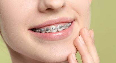 Kieferorthopädie - Festsitzende Zahnspange