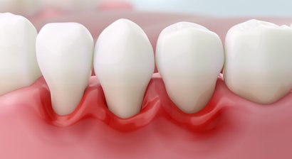 Parodontalchirurgische Maßnahmen