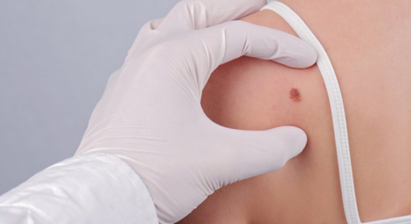 Hautkrebsoperationen - OÄ Dr. Heike Klepetko, PhD - Plastische Chirurgin Wien 1190