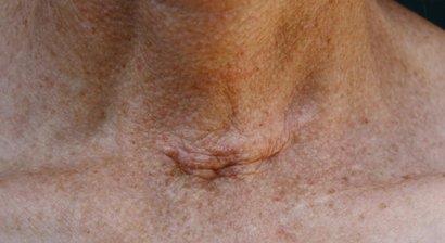 Schilddrüsenerkrankungen