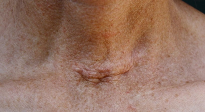 Schilddrüsenerkrankungen - Dr. Dagmar Aftenberger - Praktische Ärztin Wien 1180