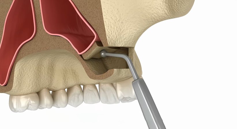 Sinuslift - Dr. Philipp Kaiser, MMSc LLM - Zahnarzt Draßburg 7021