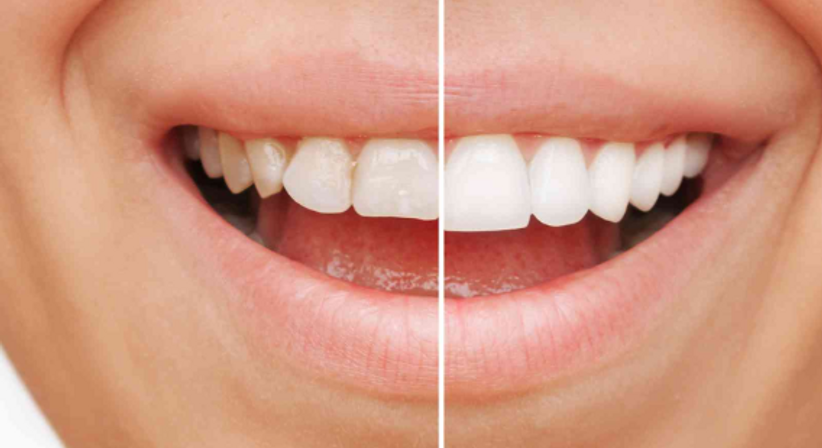 Cerec - Dr. Philipp Kaiser, MMSc LLM - Zahnarzt Draßburg 7021