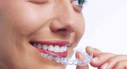 Unsichtbare Zahnspange / Aligner
