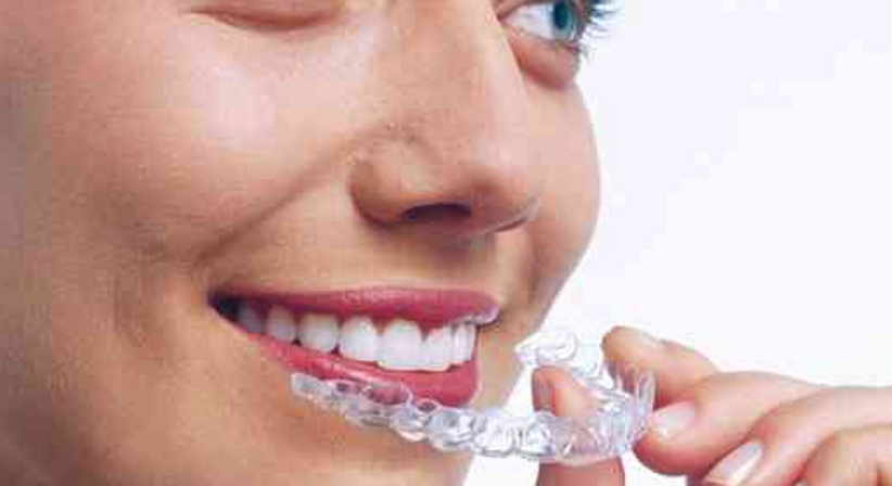 Unsichtbare Zahnspange / Aligner - Dr. Philipp Kaiser, MMSc LLM - Zahnarzt Draßburg 7021