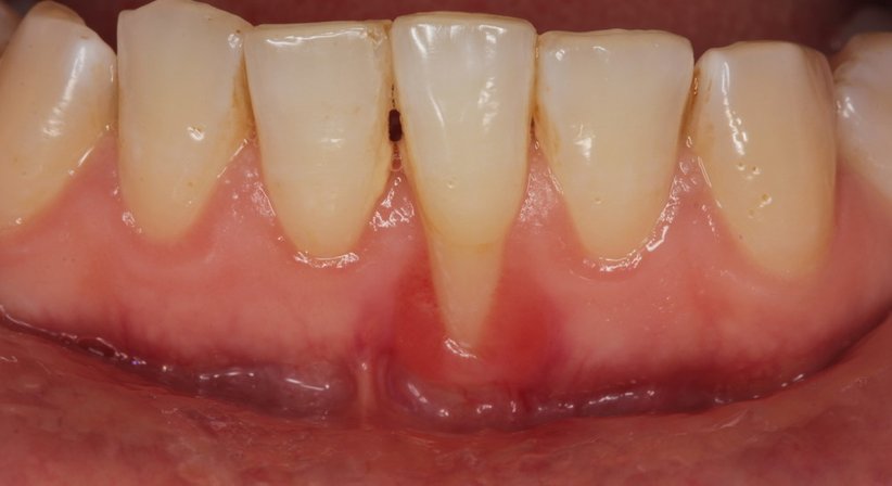Parodontaltherapie - Dr. Philipp Kaiser, MMSc LLM - Zahnarzt Draßburg 7021