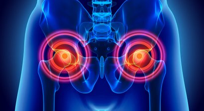 Behandlung von Knorpelschäden an der Hüfte