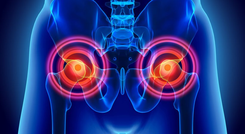 Behandlung von Knorpelschäden an der Hüfte - Prim. Dr. Werner Anderl - Orthopäde Mödling 2340