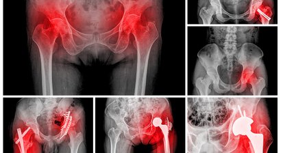 Hyaluronsäuretherapie bei Arthrose