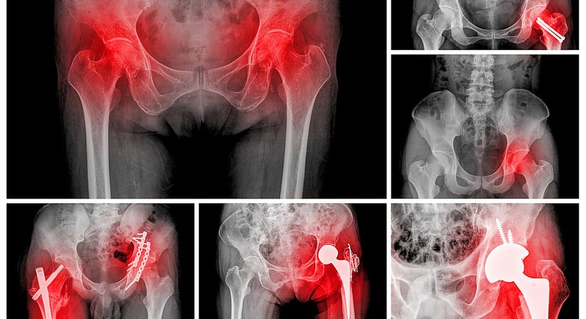 Hyaluronsäuretherapie bei Arthrose - Prim. Dr. Werner Anderl - Orthopäde Mödling 2340