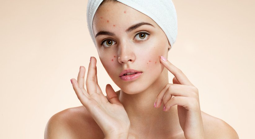 Akne - Dr. Hannes Trattner - Hautarzt Wien 1090