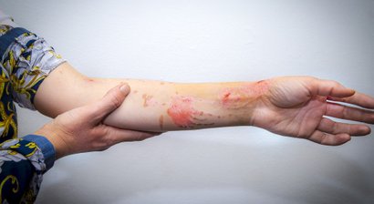 Behandlung von Narben