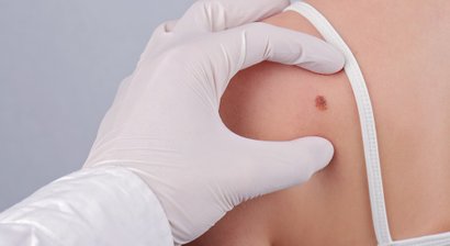 Muttermal / Muttermalkontrolle / Muttermalentfernung