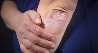 Psoriasis(Schuppenflechte)