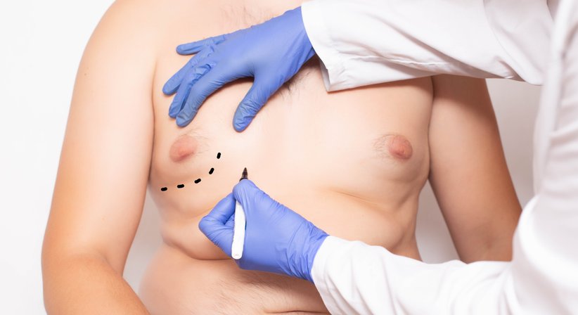 Gynäkomastie (Männliche Brust) - OA Dr. Philipp Schatten - Plastischer Chirurg Groß-Enzersdorf 2301