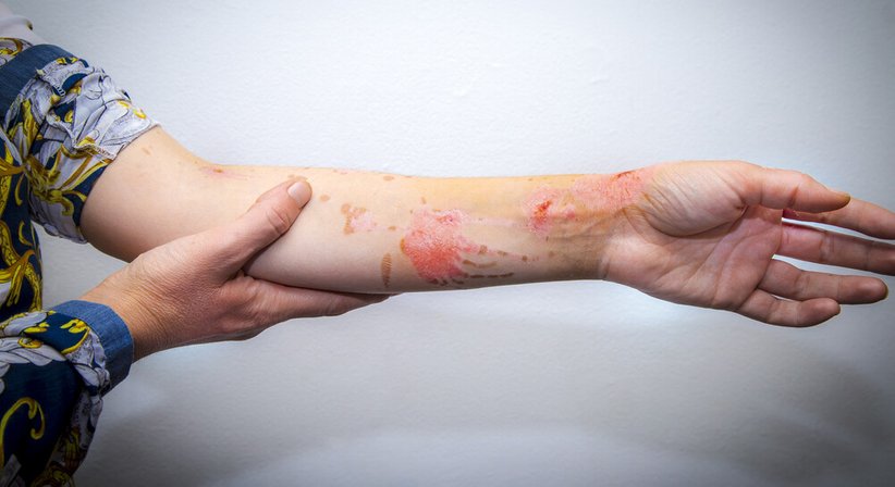 Narbenkorrektur - OA Dr. Philipp Schatten - Plastischer Chirurg Groß-Enzersdorf 2301