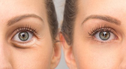 Ober- und Unterlidkorrektur