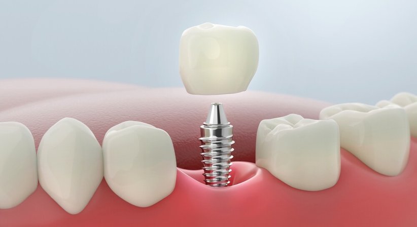 Prothesen - Dr. Marielle Bauer - Zahnärztin Wien 1020