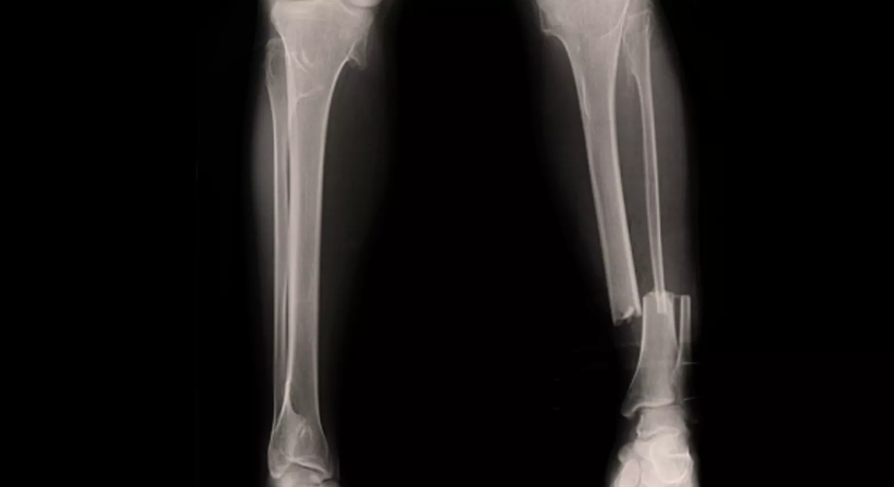 Unterschenkel Marknagel - Prim. Dr. Wolfgang Kaltenbrunner - Orthopäde Wien 1040