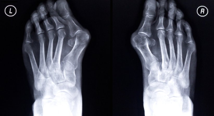 Hallux valgus - OA Dr. Günter Stolz - Orthopäde Wien 1130