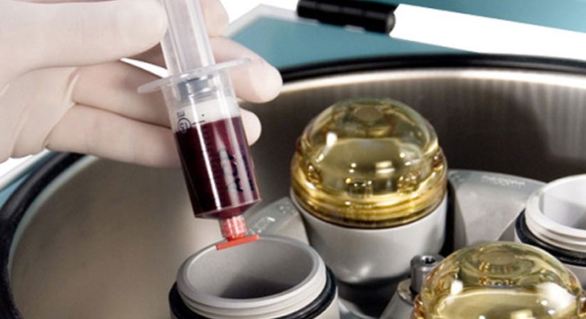 Knorpelaufbau ACP - OA Dr. Fernas Amir - Orthopäde Wien 1190