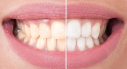 Bleaching -