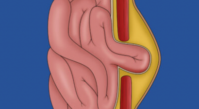 Narbenhernie  | Narbenbruchoperationen mit dem DaVinci System